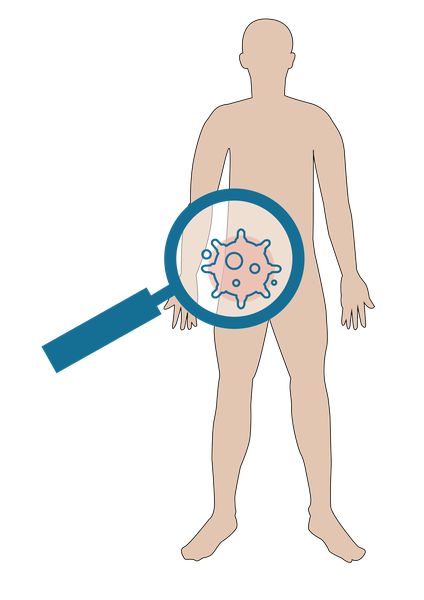 Eine Lupe durchsucht einen Körper auf Krebszellen